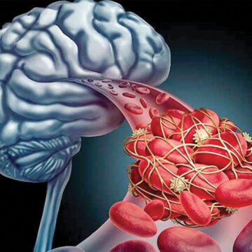 Infarto cerebral es la segunda causa de discapacidad en México